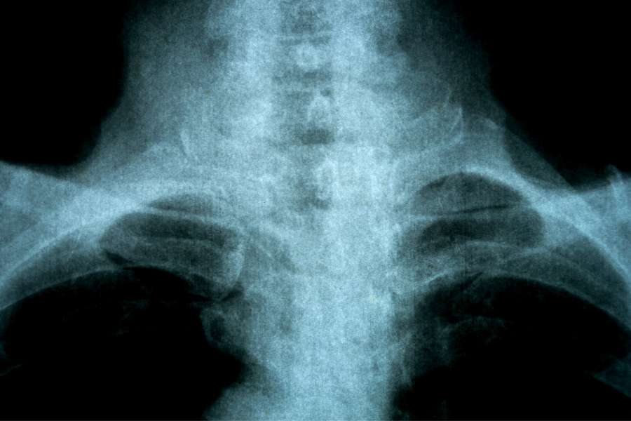 Artrodesis: qué es y cómo se realiza