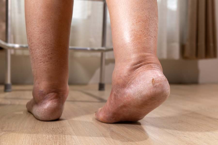 ¿Se puede trabajar con un edema óseo?
