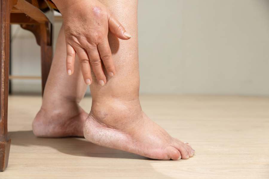 Edema óseo: causas, síntomas y tratamientos